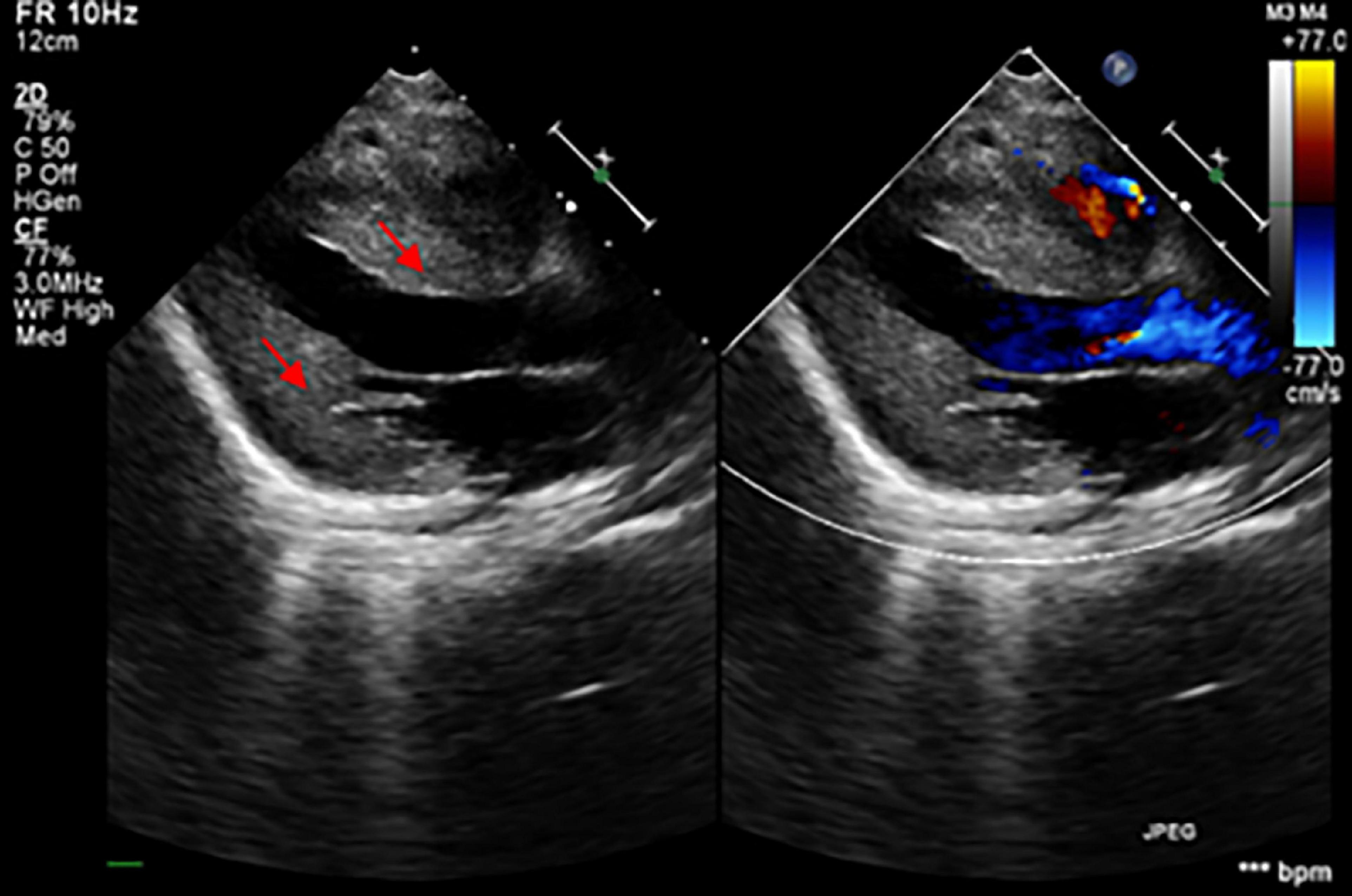 Case report: Rare novel MIPEP compound heterozygous variants presenting with hypertrophic cardiomyopathy, severe lactic acidosis and hypotonia in a Chinese infant